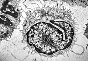 M,66y. | blood - hairy cell leukemia M,66y. | blood - hairy cell leukemia